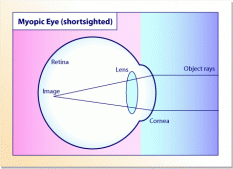 myopic_eye
